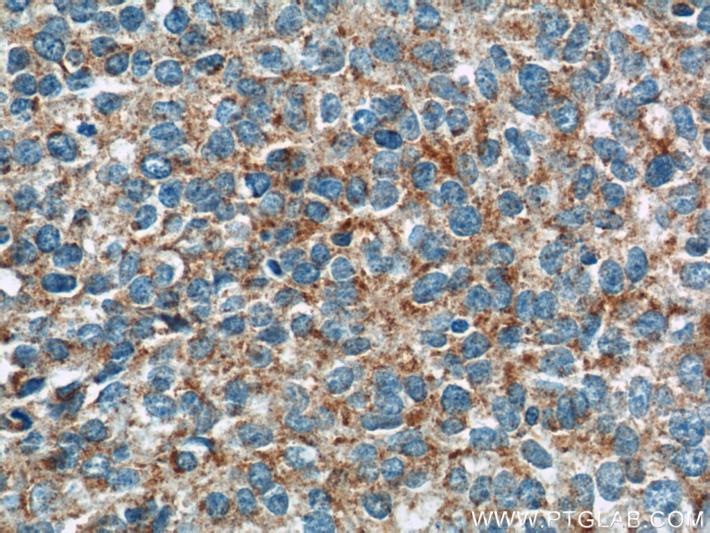 Immunohistochemistry (IHC) staining of human cervical cancer tissue using GKAP1 Polyclonal antibody (11395-1-AP)