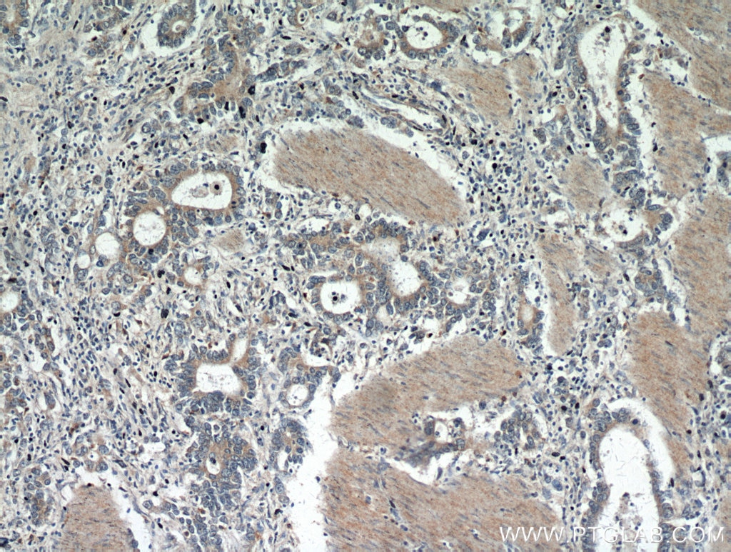 Immunohistochemistry (IHC) staining of human stomach cancer tissue using Gastrokine 1 Polyclonal antibody (14494-1-AP)