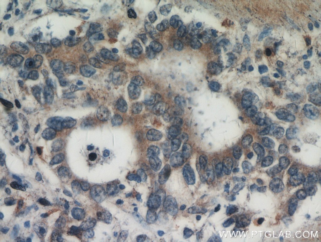 Immunohistochemistry (IHC) staining of human stomach cancer tissue using Gastrokine 1 Polyclonal antibody (14494-1-AP)