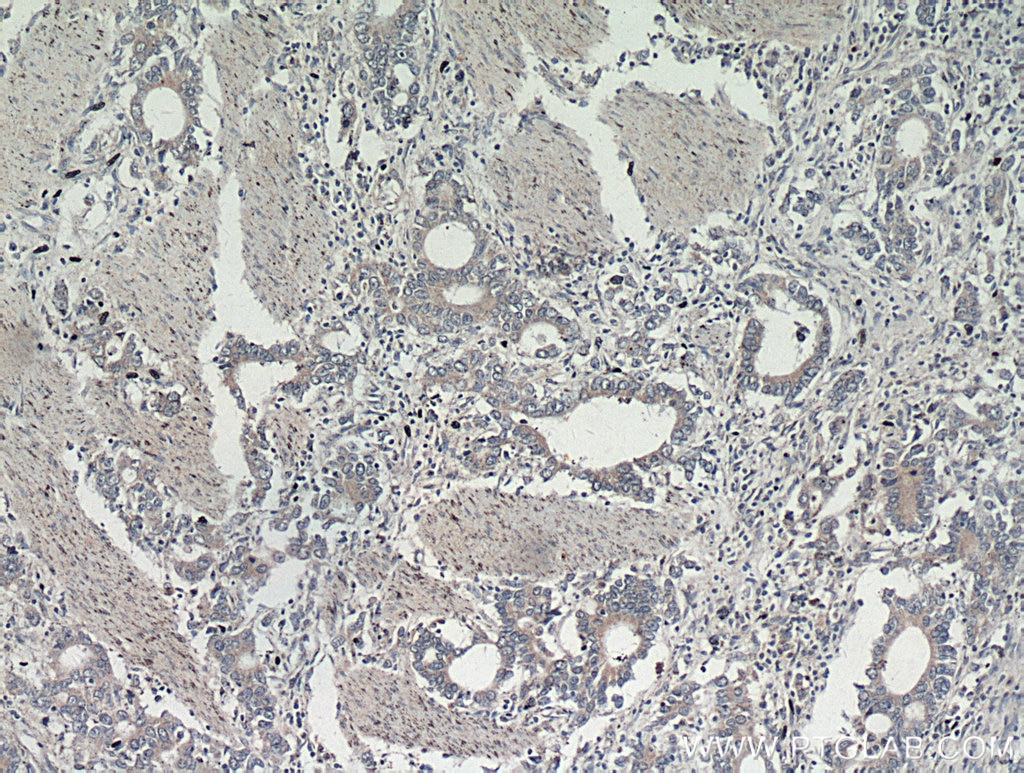 Immunohistochemistry (IHC) staining of human stomach cancer tissue using Gastrokine 1 Polyclonal antibody (14494-1-AP)