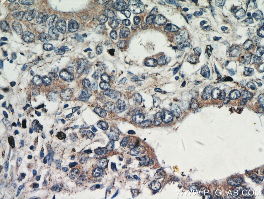 Immunohistochemistry (IHC) staining of human stomach cancer tissue using Gastrokine 1 Polyclonal antibody (14494-1-AP)