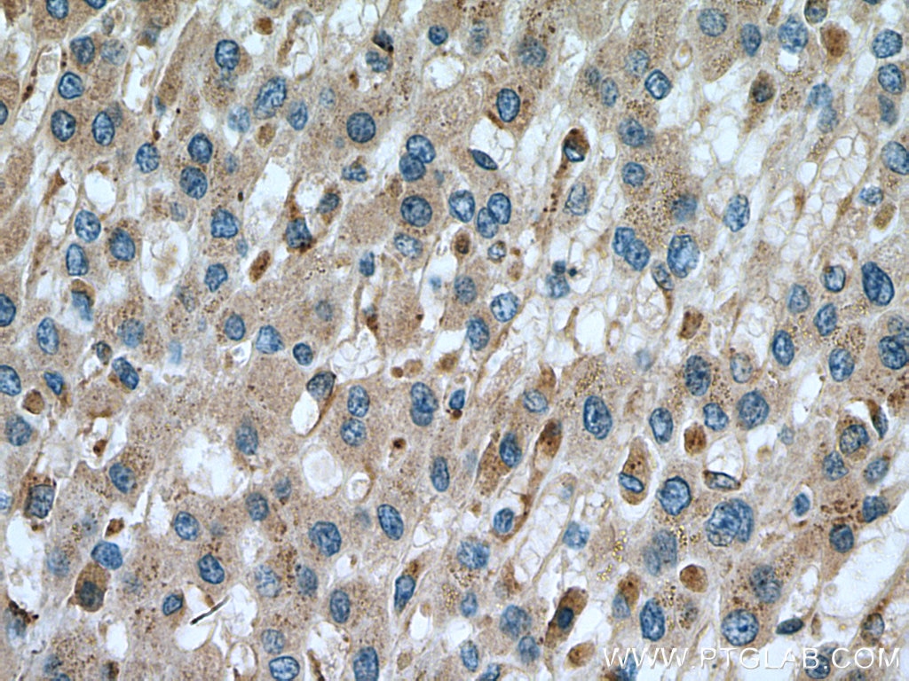 Immunohistochemistry (IHC) staining of human liver cancer tissue using Alpha Galactosidase A Polyclonal antibody (15428-1-AP)