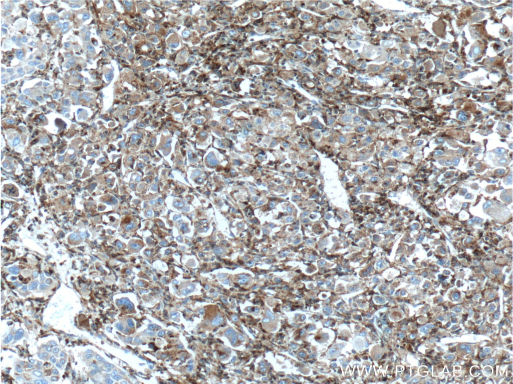 Immunohistochemistry (IHC) staining of human liver cancer tissue using Alpha Galactosidase A Polyclonal antibody (15428-1-AP)