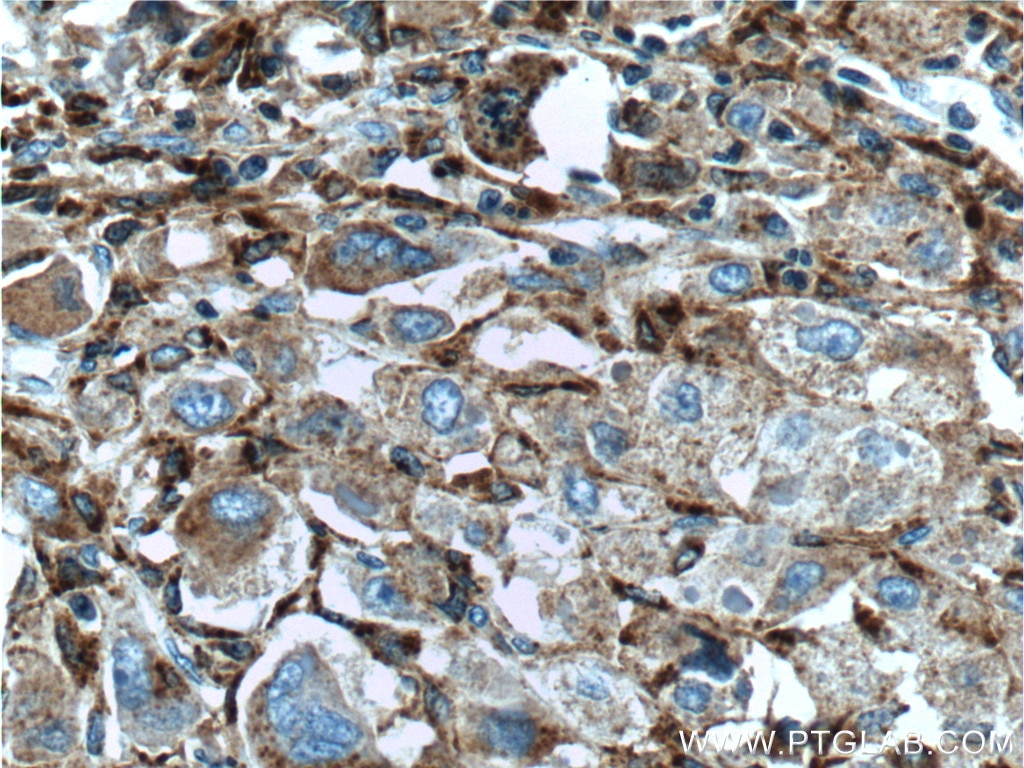 Immunohistochemistry (IHC) staining of human liver cancer tissue using Alpha Galactosidase A Polyclonal antibody (15428-1-AP)