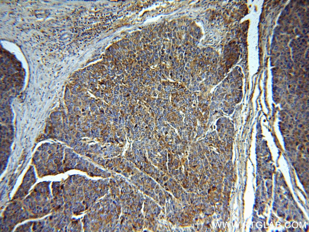 Immunohistochemistry (IHC) staining of human liver cancer tissue using Alpha Galactosidase A Polyclonal antibody (15428-1-AP)