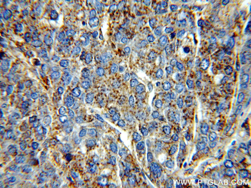 IHC staining of human liver cancer using 15428-1-AP