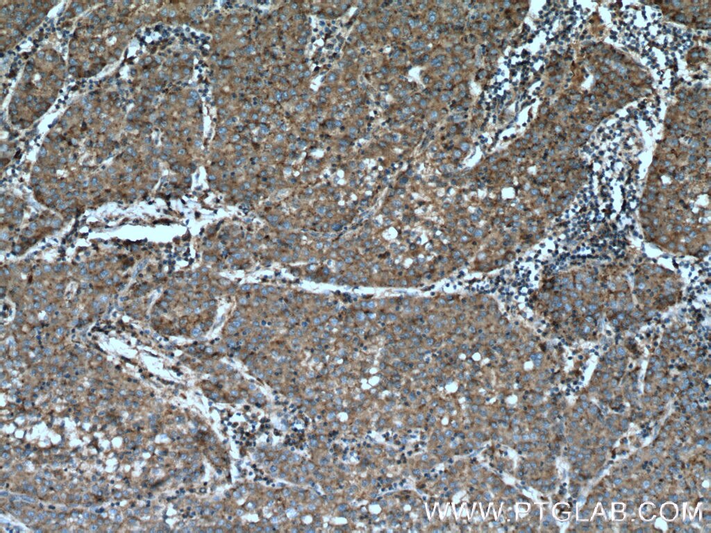 Immunohistochemistry (IHC) staining of human liver cancer tissue using Beta Galactosidase Polyclonal antibody (15518-1-AP)