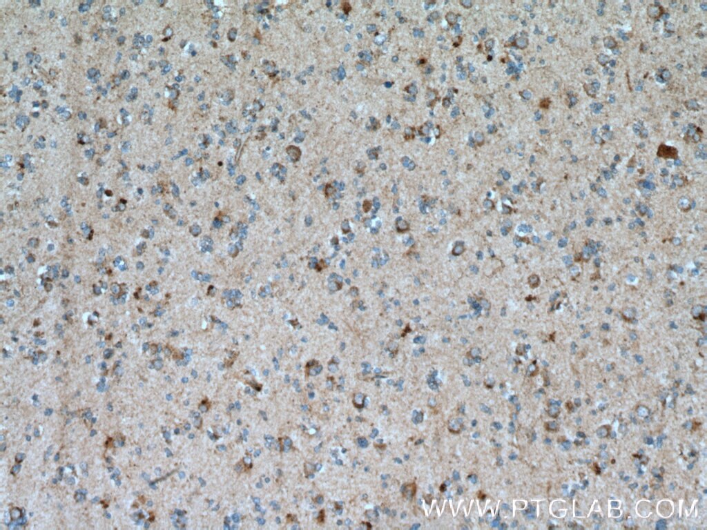 Immunohistochemistry (IHC) staining of human gliomas tissue using Beta Galactosidase Polyclonal antibody (15518-1-AP)