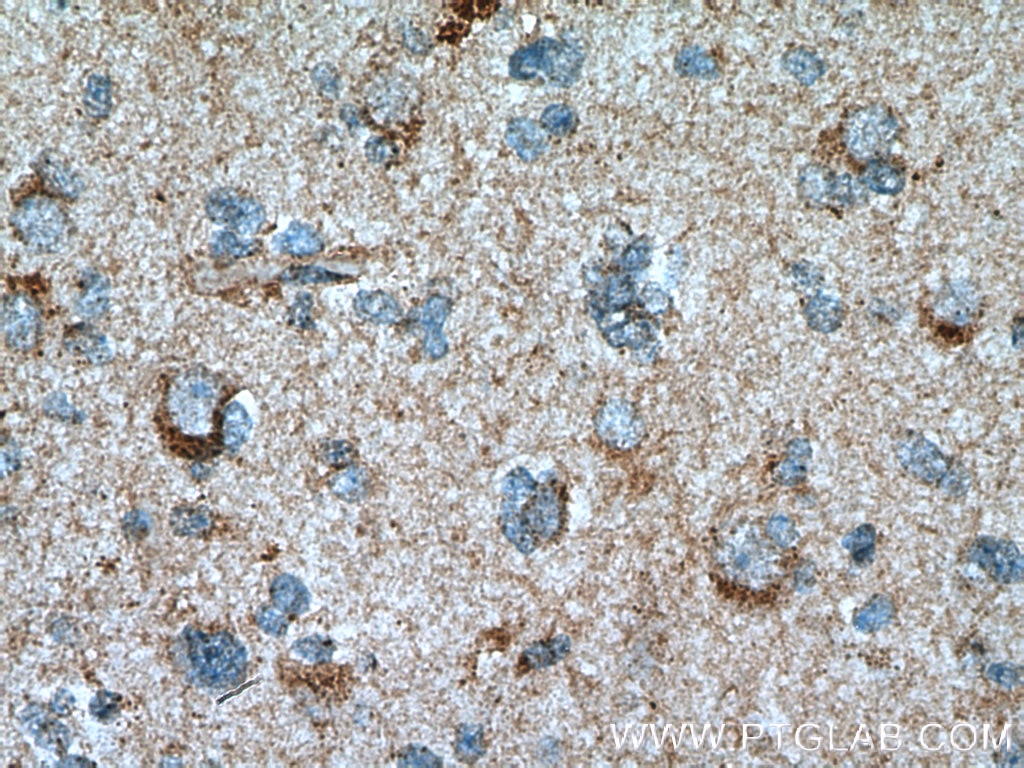 Immunohistochemistry (IHC) staining of human gliomas tissue using Beta Galactosidase Polyclonal antibody (15518-1-AP)