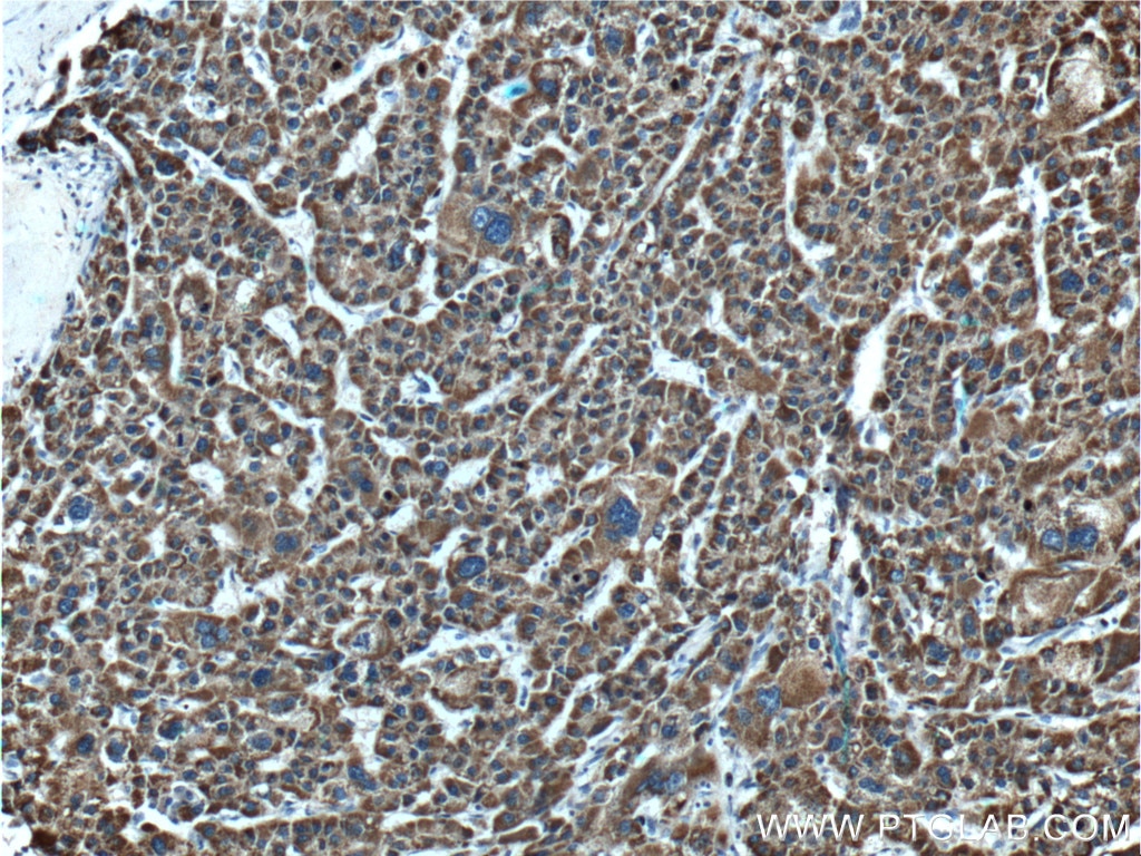 Immunohistochemistry (IHC) staining of human liver cancer tissue using GLDC Polyclonal antibody (24827-1-AP)