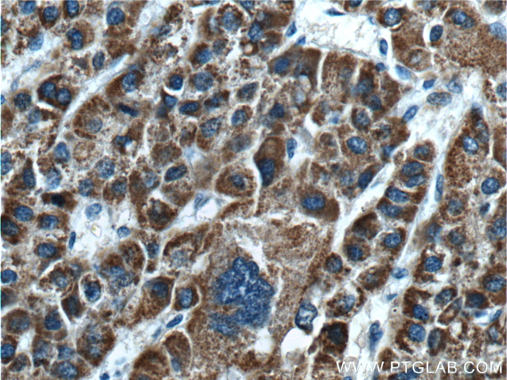 Immunohistochemistry (IHC) staining of human liver cancer tissue using GLDC Polyclonal antibody (24827-1-AP)