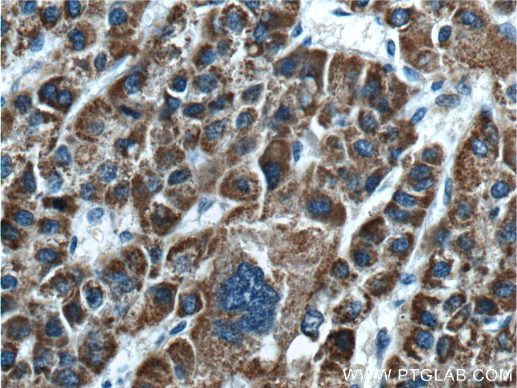 IHC staining of human liver cancer using 24827-1-AP