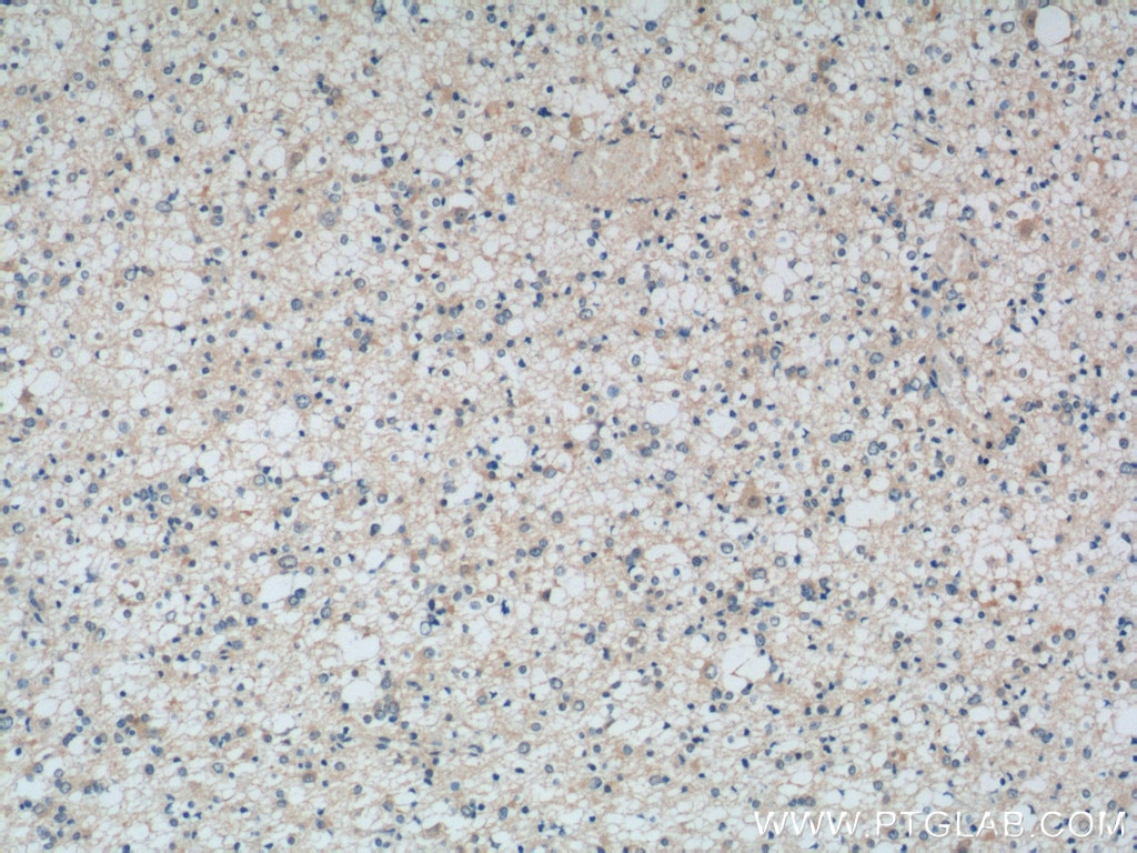 IHC staining of human gliomas using 25733-1-AP