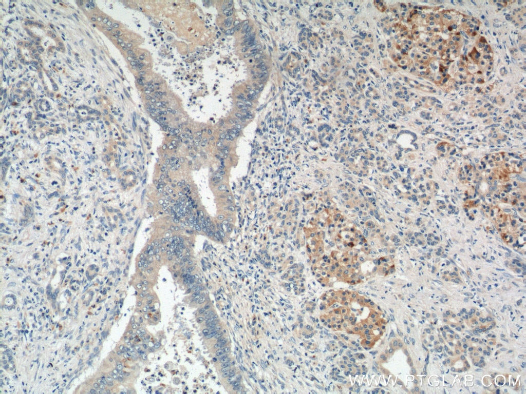 Immunohistochemistry (IHC) staining of human pancreas cancer tissue using GLI1 Polyclonal antibody (25733-1-AP)