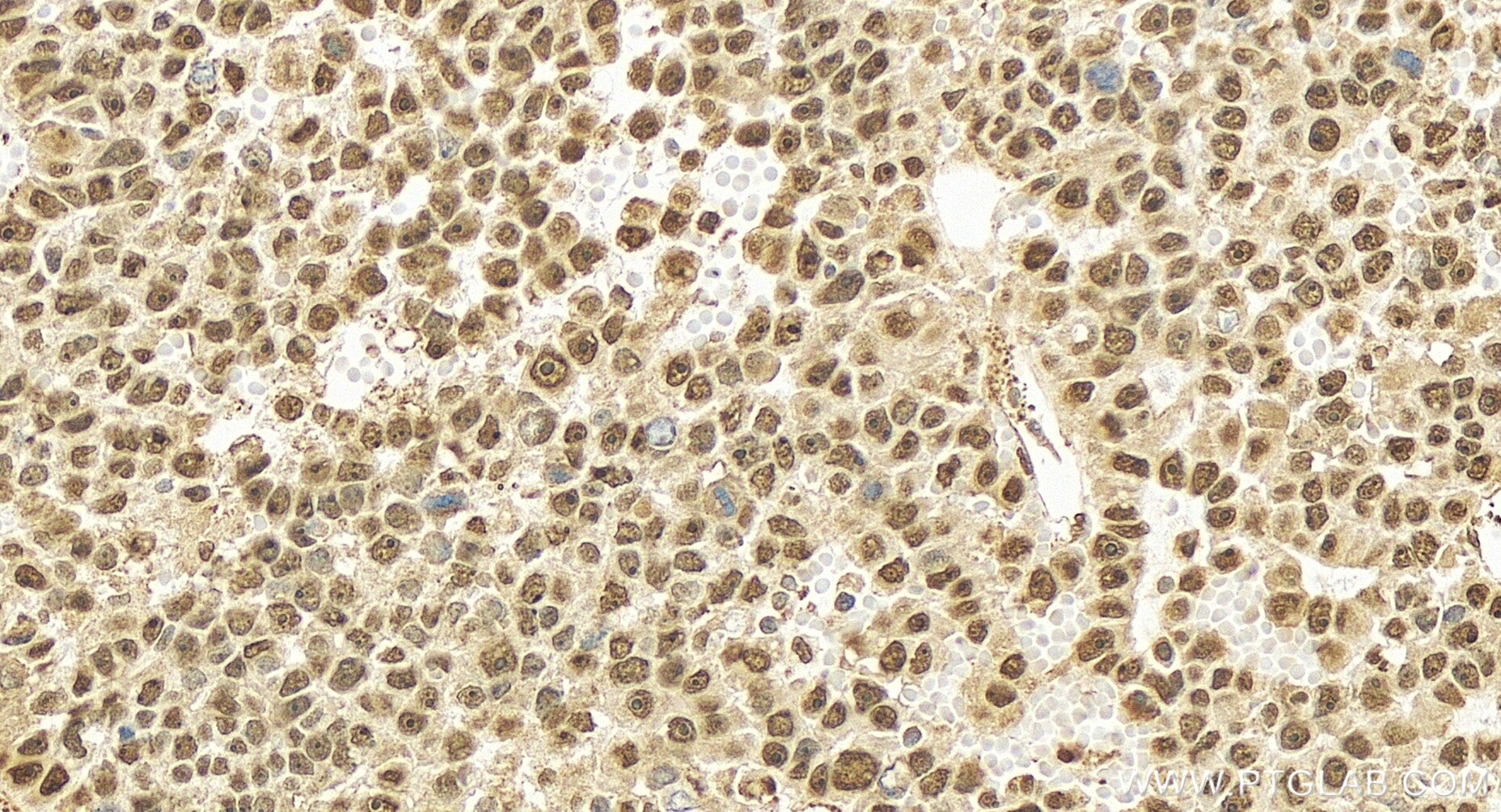 Immunohistochemistry (IHC) staining of human liver cancer tissue using GLI2-Specific Recombinant antibody (84141-1-RR)