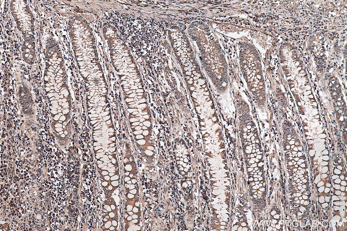 Immunohistochemistry (IHC) staining of human colon cancer tissue using GLI3 Polyclonal antibody (28272-1-AP)