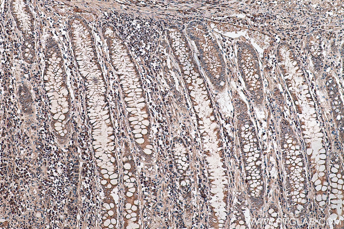 IHC staining of human colon cancer using 28272-1-AP