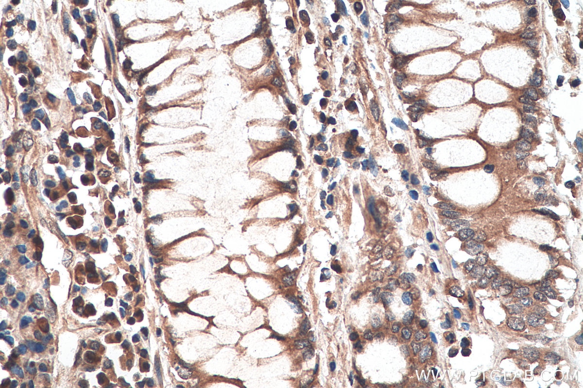 IHC staining of human colon cancer using 28272-1-AP