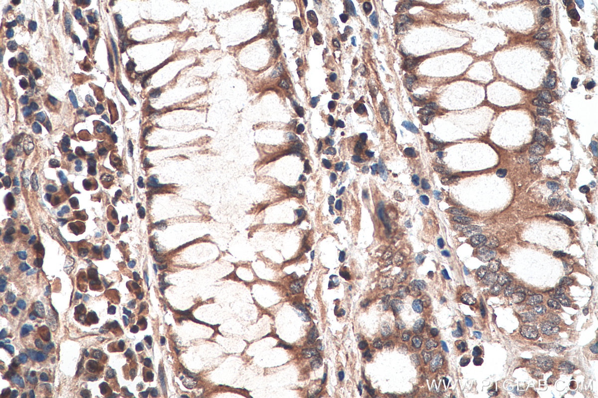 Immunohistochemistry (IHC) staining of human colon cancer tissue using GLI3 Polyclonal antibody (28272-1-AP)