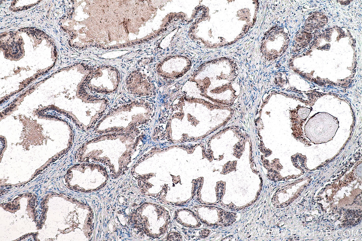 Immunohistochemistry (IHC) staining of human prostate cancer tissue using GLI3 Polyclonal antibody (28272-1-AP)