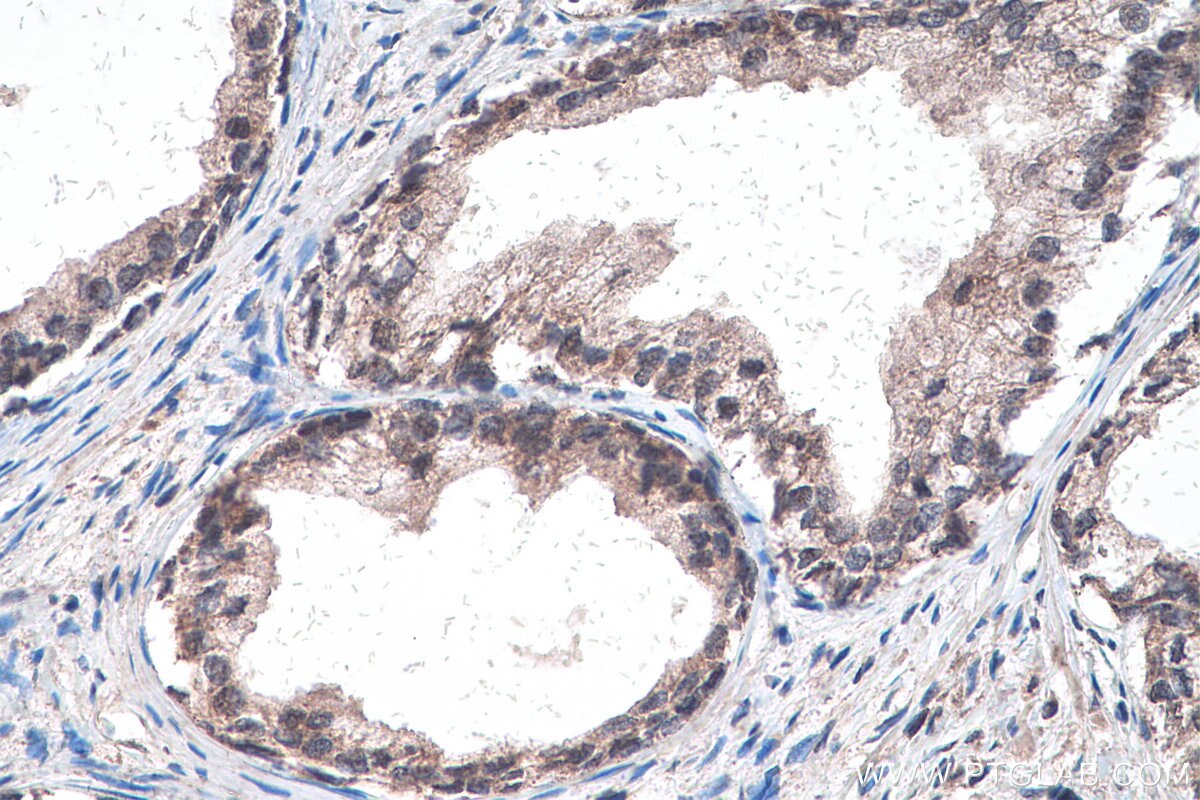 Immunohistochemistry (IHC) staining of human prostate cancer tissue using GLI3 Polyclonal antibody (28272-1-AP)