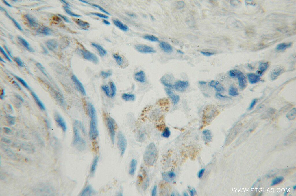 Immunohistochemistry (IHC) staining of human lung cancer tissue using GLIPR1 Polyclonal antibody (12517-1-AP)