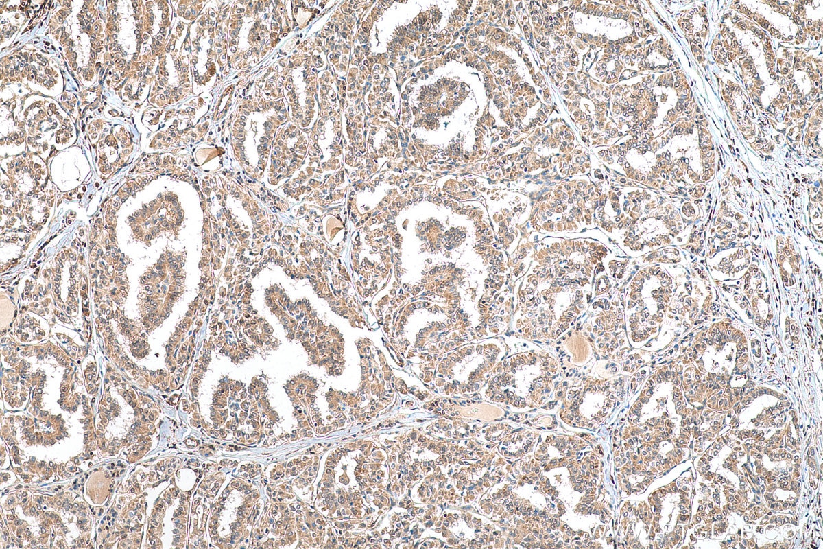 Immunohistochemistry (IHC) staining of human thyroid cancer tissue using GLO1 Polyclonal antibody (15140-1-AP)