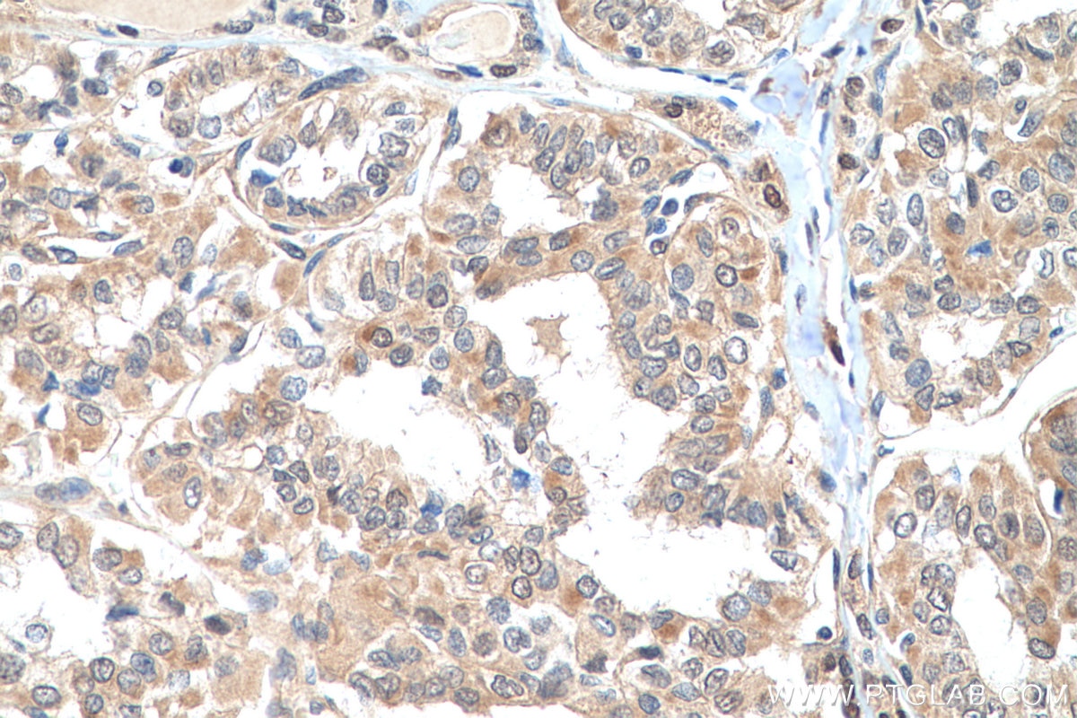 Immunohistochemistry (IHC) staining of human thyroid cancer tissue using GLO1 Polyclonal antibody (15140-1-AP)
