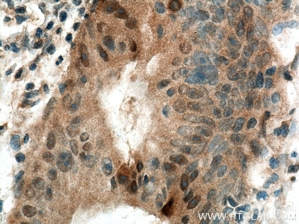 Immunohistochemistry (IHC) staining of human colon cancer tissue using GLRX3 Polyclonal antibody (11254-1-AP)
