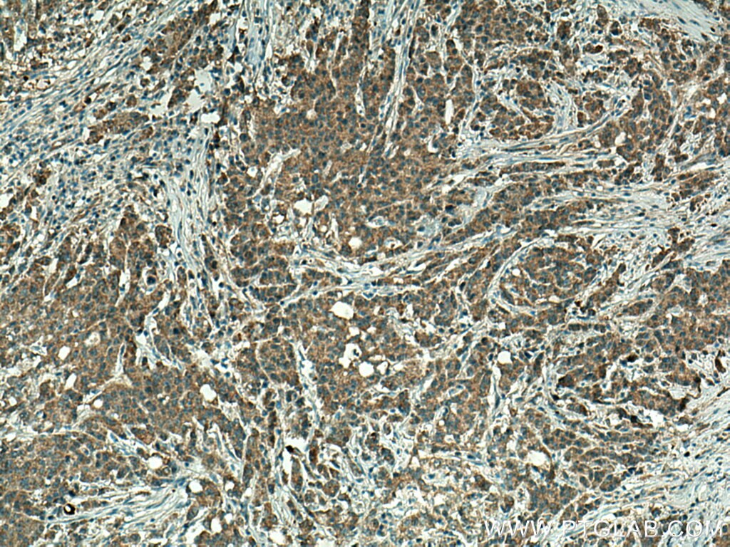 Immunohistochemistry (IHC) staining of human stomach cancer tissue using GLRX3 Polyclonal antibody (11254-1-AP)