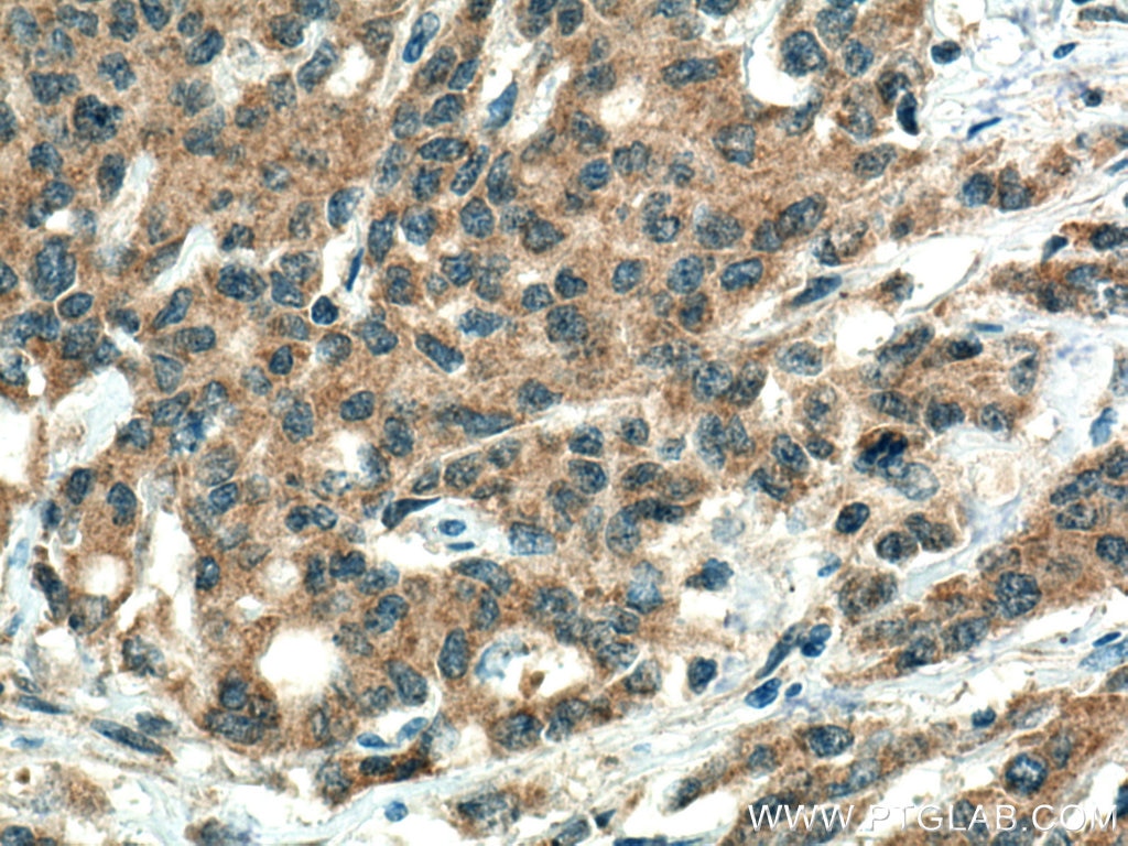 Immunohistochemistry (IHC) staining of human stomach cancer tissue using GLRX3 Polyclonal antibody (11254-1-AP)