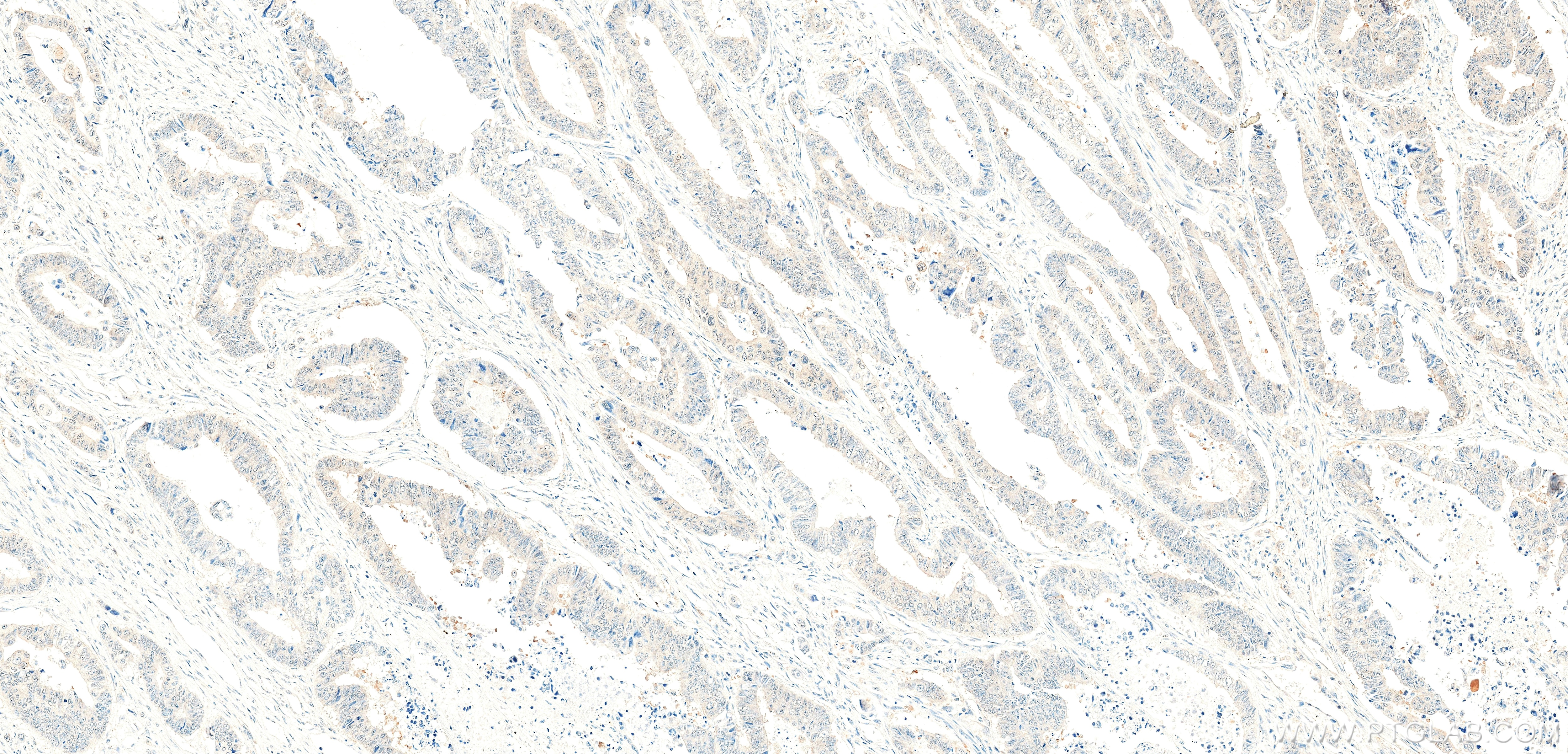 IHC staining of human colon cancer using 86587-1-RR (same clone as 86587-1-PBS) Immunohistochemistry (IHC) staining of human colon cancer tissue using GLRX3 Recombinant monoclonal antibody (86587-1-RR)