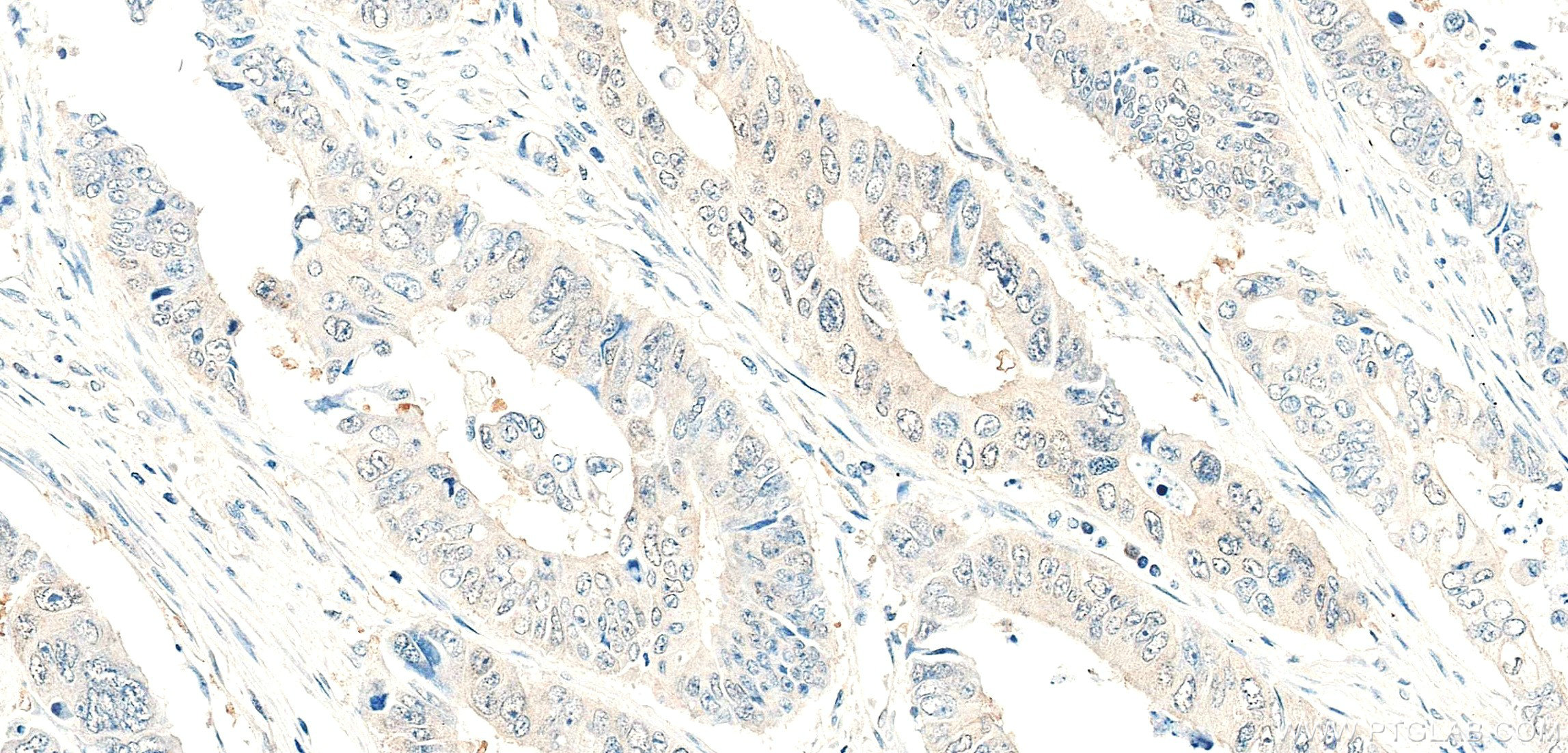 IHC staining of human colon cancer using 86587-1-RR (same clone as 86587-1-PBS) Immunohistochemistry (IHC) staining of human colon cancer tissue using GLRX3 Recombinant monoclonal antibody (86587-1-RR)