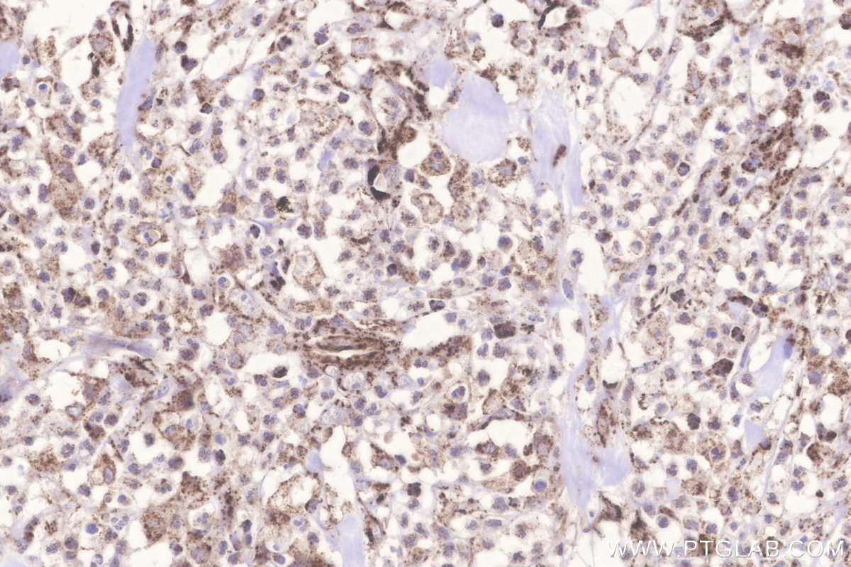 IHC staining of human colon cancer using 18884-1-AP Immunohistochemistry (IHC) staining of human colon cancer tissue using Glutaredoxin 5 Polyclonal antibody (18884-1-AP)