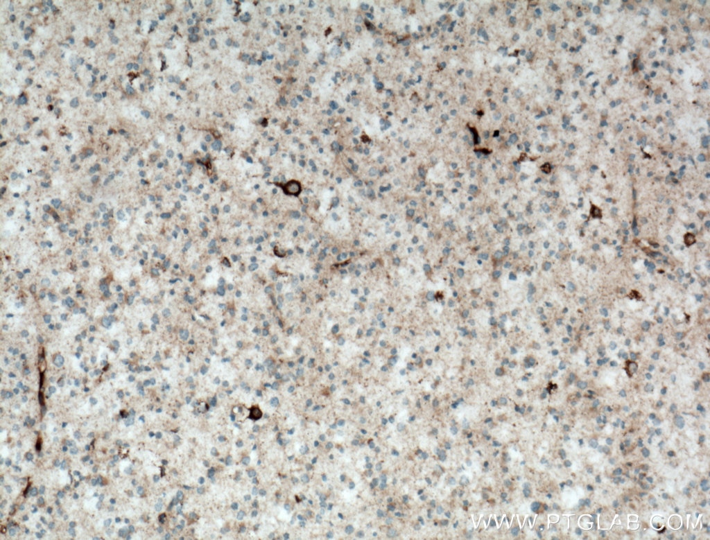 Immunohistochemistry (IHC) staining of human gliomas tissue using KGA/GAC Polyclonal antibody (12855-1-AP)