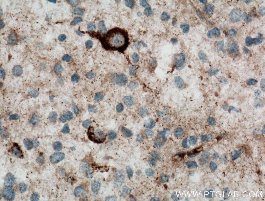 Immunohistochemistry (IHC) staining of human gliomas tissue using KGA/GAC Polyclonal antibody (12855-1-AP)