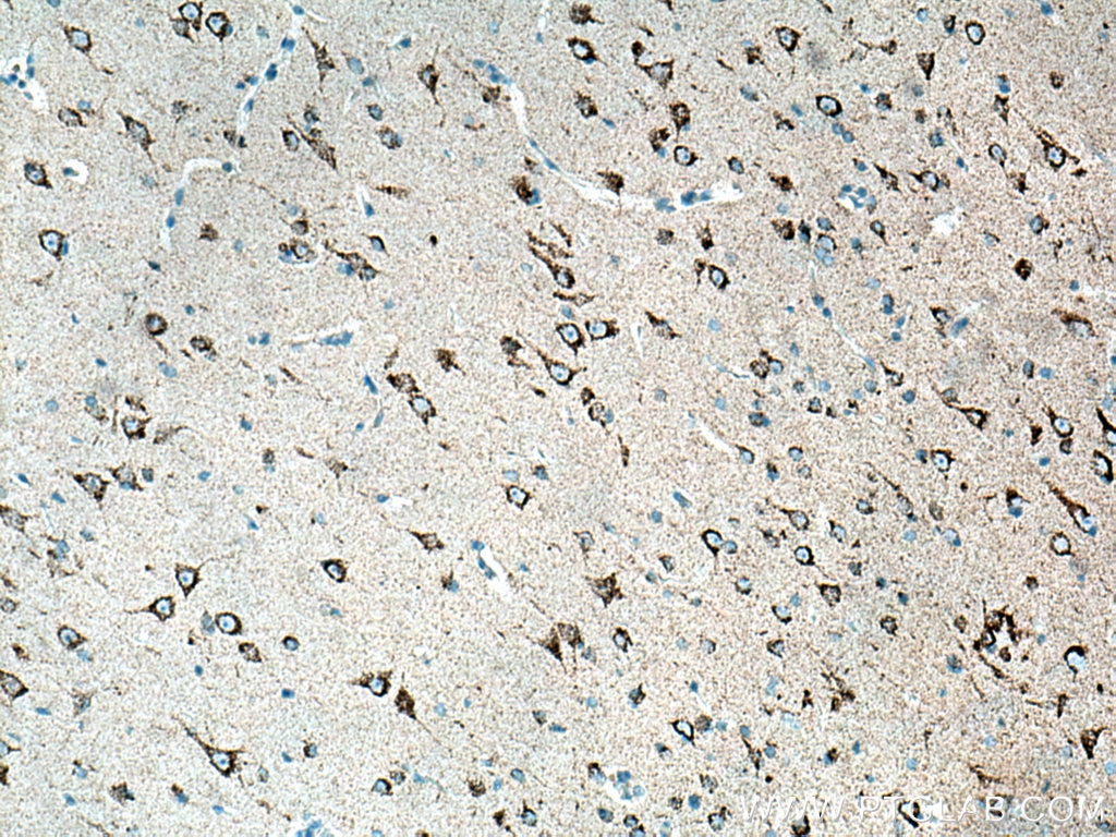 IHC staining of human gliomas using 12855-1-AP
