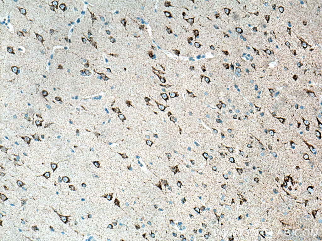 Immunohistochemistry (IHC) staining of human gliomas tissue using KGA/GAC Polyclonal antibody (12855-1-AP)