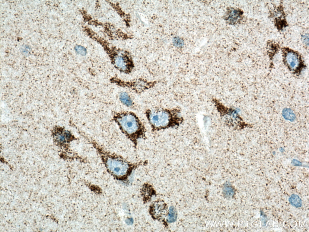 Immunohistochemistry (IHC) staining of human gliomas tissue using KGA/GAC Polyclonal antibody (12855-1-AP)