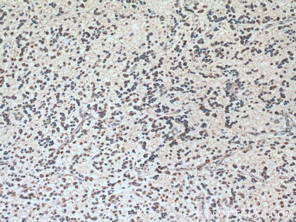 Immunohistochemistry (IHC) staining of human gliomas tissue using KGA/GAC Monoclonal antibody (66265-1-Ig)