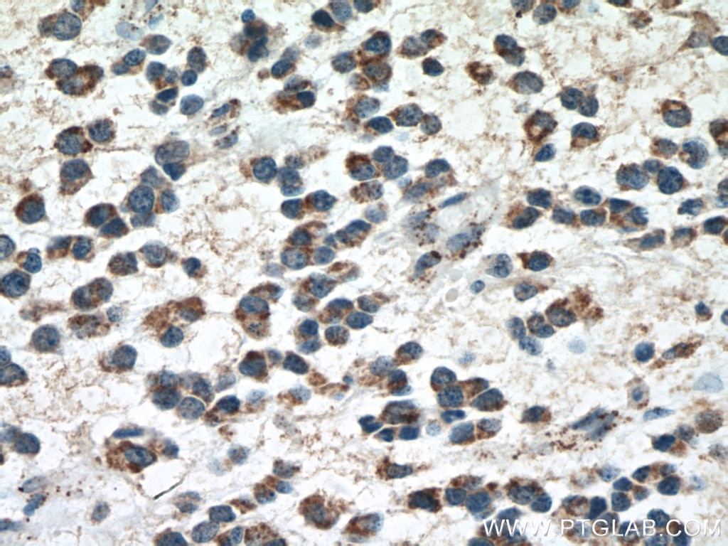 Immunohistochemistry (IHC) staining of human gliomas tissue using KGA/GAC Monoclonal antibody (66265-1-Ig)