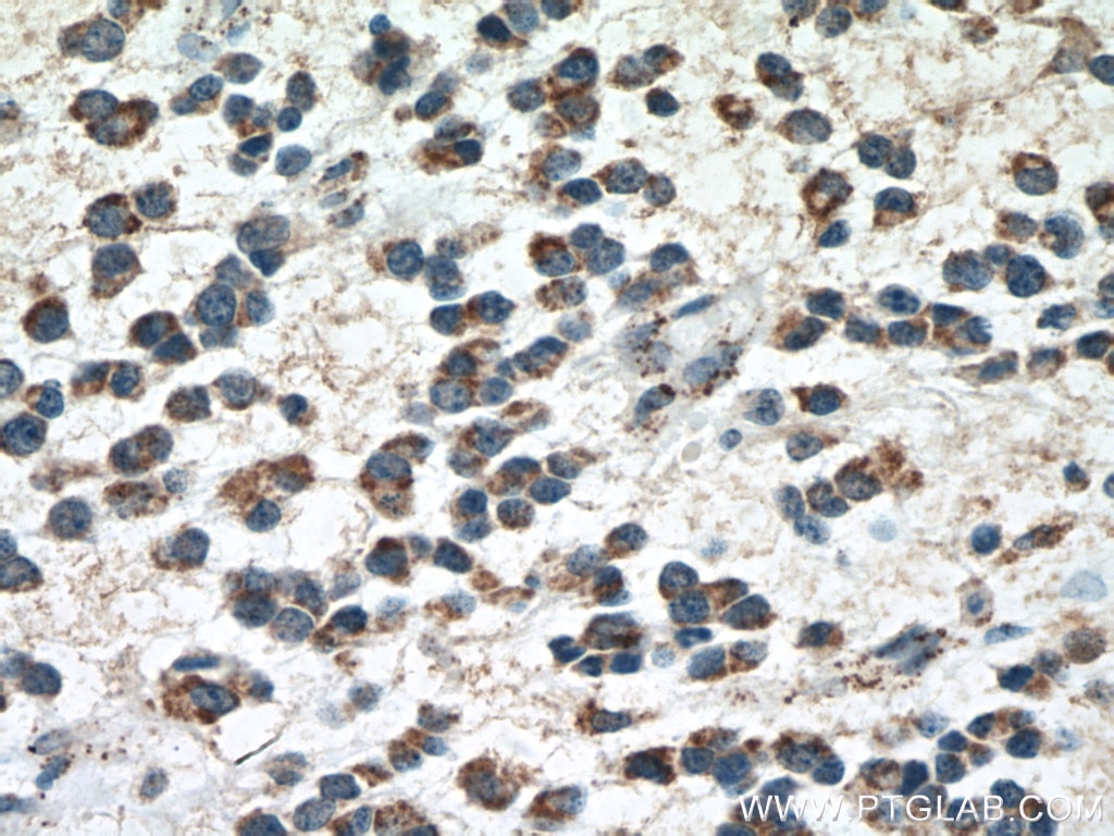 IHC staining of human gliomas using 66265-1-Ig