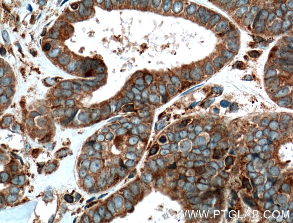 Immunohistochemistry (IHC) staining of human ovary tumor tissue using GLT25D1 Polyclonal antibody (16768-1-AP)
