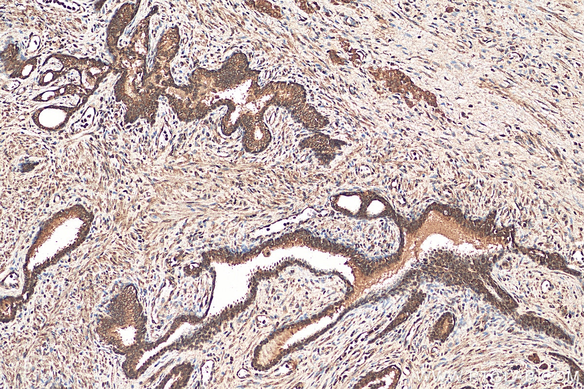 Immunohistochemistry (IHC) staining of human prostate cancer tissue using GLTSCR2 Polyclonal antibody (27353-1-AP)