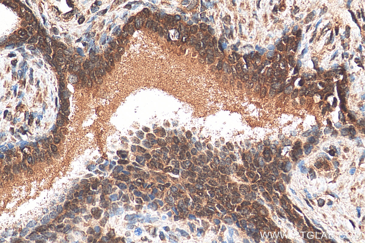 Immunohistochemistry (IHC) staining of human prostate cancer tissue using GLTSCR2 Polyclonal antibody (27353-1-AP)