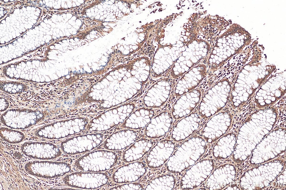 Immunohistochemistry (IHC) staining of human colon cancer tissue using GLTSCR2 Polyclonal antibody (27353-1-AP)