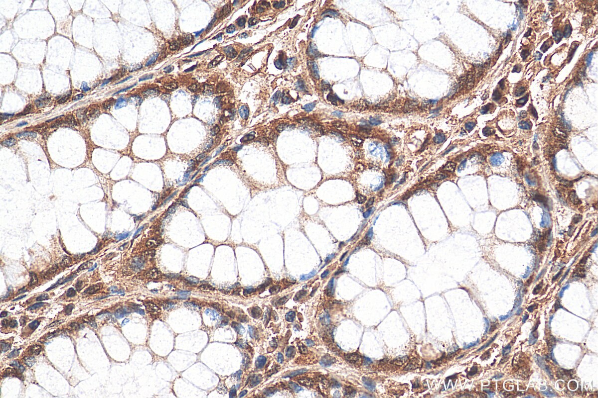 Immunohistochemistry (IHC) staining of human colon cancer tissue using GLTSCR2 Polyclonal antibody (27353-1-AP)