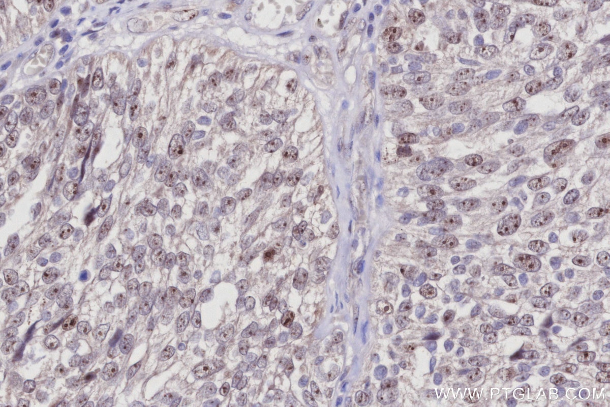 IHC staining of human ovary cancer using 27353-1-AP Immunohistochemistry (IHC) staining of human ovary cancer tissue using GLTSCR2 Polyclonal antibody (27353-1-AP)