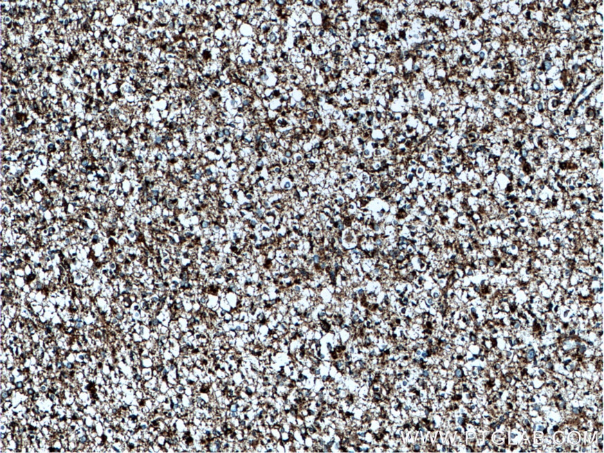 IHC staining of human gliomas using 14299-1-AP