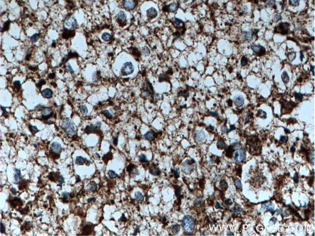 Immunohistochemistry (IHC) staining of human gliomas tissue using GLUD1 Polyclonal antibody (14299-1-AP)